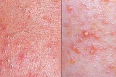 Difference between blackheads and whiteheads Difference between blackheads and whiteheads