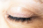 Eyelash Dandruff symptoms, Eyelash Dandruff health, all about eyelash dandruff, Conjunctivitis