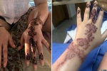 black henna side effects, henna burns treatment, henna tattoo cause aussie woman to almost lose her hand, Tattoos