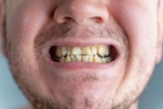 Nicotine stains breaking, Nicotine stains research, are nicotine stains on your teeth irreversible, Bad breath