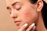 skin care, skin care products, 10 ways to get rid of pimples at home, Dandruff
