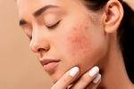 skin care products, skin care products, 10 ways to get rid of pimples at home, Home remedies