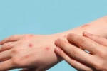 Monkeypox symptoms, Monkeypox news, study says that the symptoms of monkeypox are different from earlier, Monk